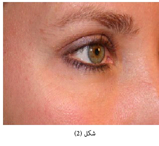 جراحی زیبایی چشم